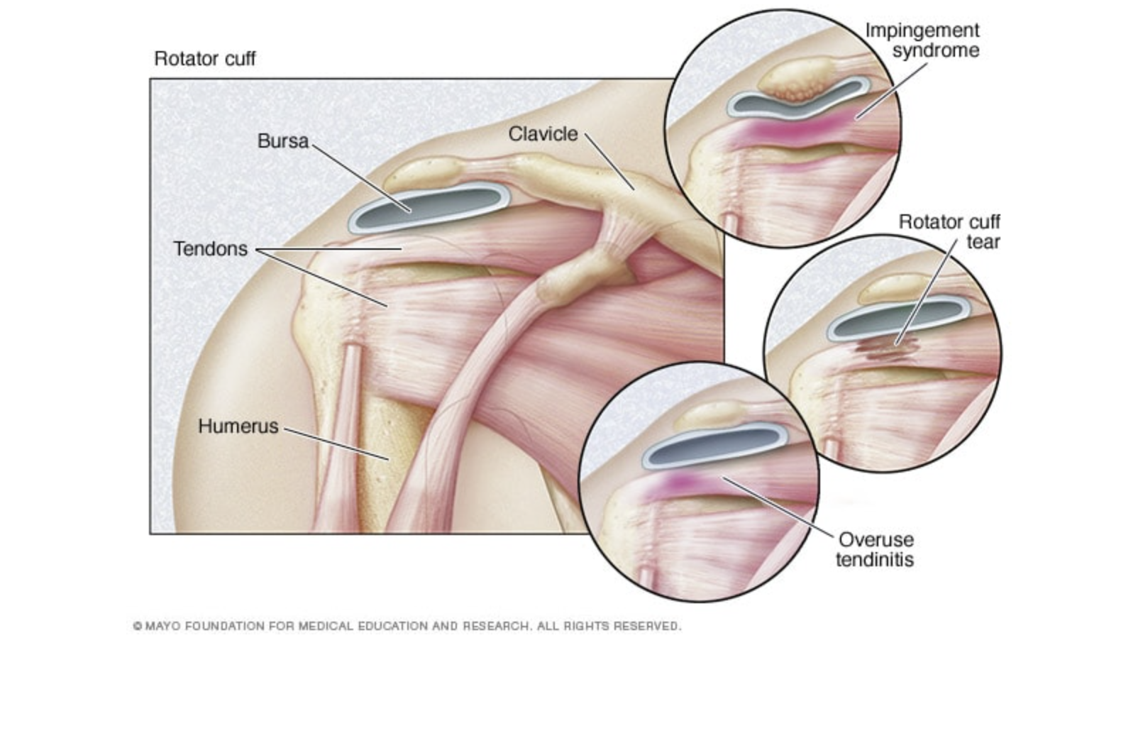 Types of rotator cuff injuries
