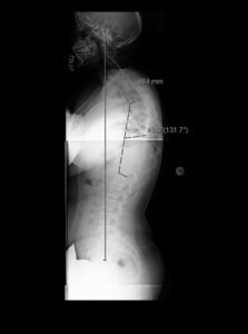 1 223x300 - 16 yo girl with progressive scoliosis despite bracing
