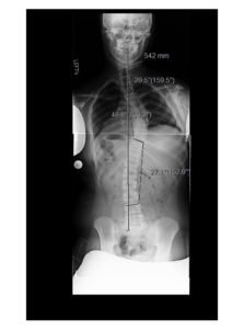 2 223x300 - 16 yo girl with progressive scoliosis despite bracing