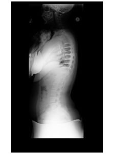 3 223x300 - 16 yo girl with progressive scoliosis despite bracing