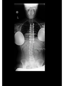 4 223x300 - 16 yo girl with progressive scoliosis despite bracing