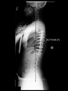 17 woman with progressive adolescent curve despite bracing. CB po lat 224x300 - 17 woman with progressive adolescent curve despite bracing.
