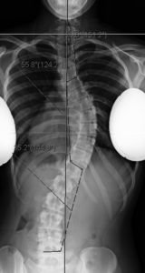 17 woman with progressive adolescent curve despite bracing. CB preop AP 160x300 - 17 woman with progressive adolescent curve despite bracing.