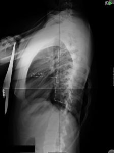 17 woman with progressive adolescent curve despite bracing. CB preop lat 224x300 - 17 woman with progressive adolescent curve despite bracing.
