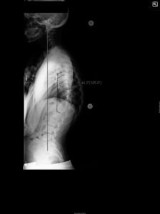 17 yo young male with progressive scoliosis and imbalance despite non operative treatment with bracing. SB PO.lat 224x300 - 17 yo young male with progressive scoliosis and imbalance despite non operative treatment with bracing.