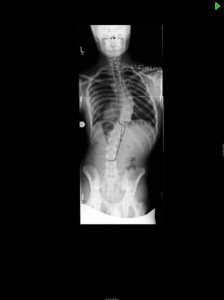 17 yo young male with progressive scoliosis and imbalance despite non operative treatment with bracing. SB po AP 224x300 - 17 yo young male with progressive scoliosis and imbalance despite non operative treatment with bracing.