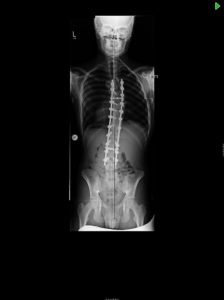 17 yo young male with progressive scoliosis and imbalance despite non operative treatment with bracing. SB po AP2 224x300 - 17 yo young male with progressive scoliosis and imbalance despite non operative treatment with bracing.