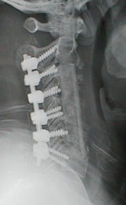 VHpostoplat 184x300 - 49 yo male with kyphosis s/p failed cervical fracture repair