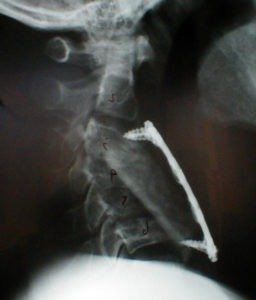 VHpreoplat 256x300 - 49 yo male with kyphosis s/p failed cervical fracture repair