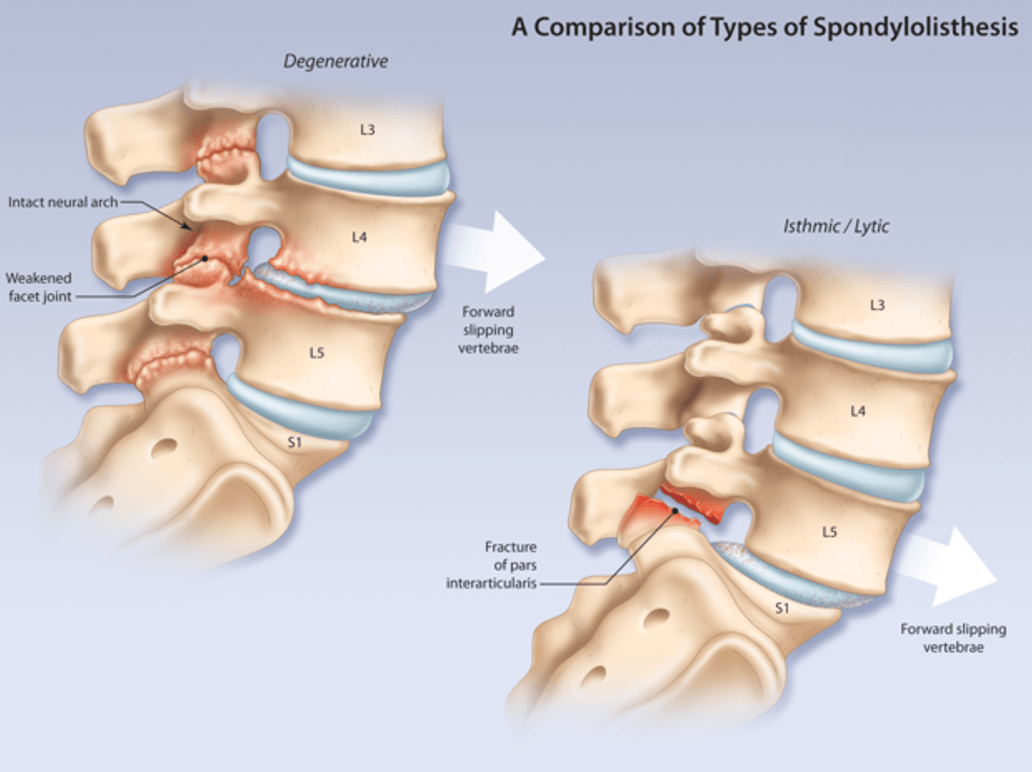Spondylolisthesis Zrzut ekranu 2016 12 12 o 17.03.28 - Spondylolisthesis