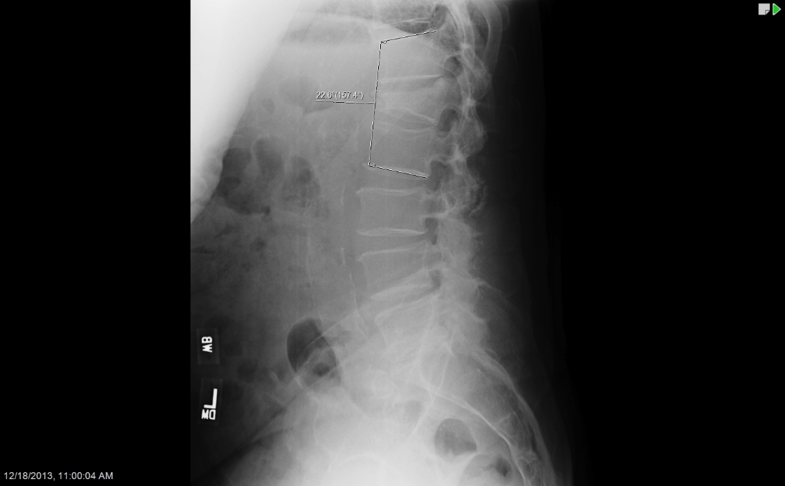 Spinal Trauma (Traumatic Fractures) Zrzut ekranu 2017 01 16 o 14.49.03 - Spinal Trauma (Traumatic Fractures)
