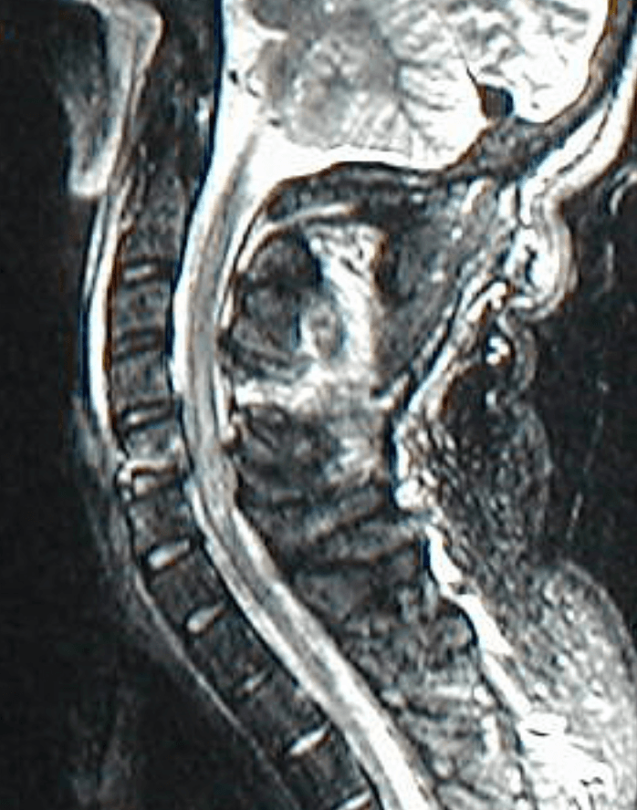 Spinal Trauma (Traumatic Fractures) Zrzut ekranu 2017 01 16 o 15.01.35 - Spinal Trauma (Traumatic Fractures)