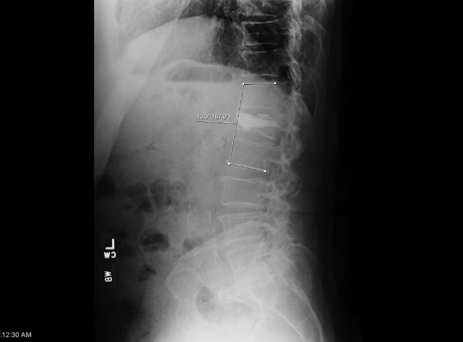 Spinal Trauma (Traumatic Fractures) Zrzut ekranu 2017 01 16 o 15.02.37 - Spinal Trauma (Traumatic Fractures)