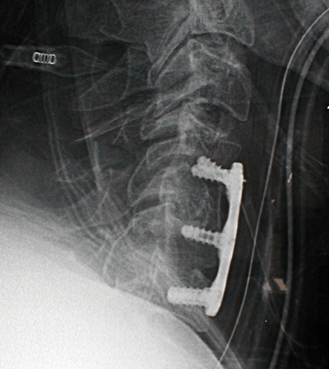 Spinal Trauma (Traumatic Fractures) Zrzut ekranu 2017 01 16 o 15.04.54 - Spinal Trauma (Traumatic Fractures)