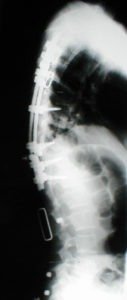 DK.postop.lateral 127x300 - Case Example 10