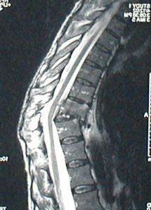 DK.sagital.mri  e1511786070744 216x300 - Case Example 10