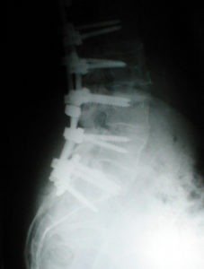 MLpostop spot lateral 227x300 - Case Example 8