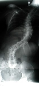 MLpreopSB 138x300 - Case Example 8