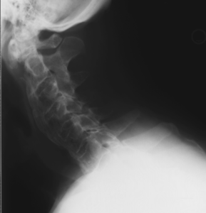 PG01 2 289x300 - 61 yo male with severe cervical stenosis and myelopathy