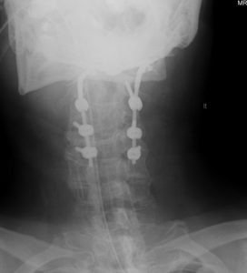 PGpostopAP 272x300 - 61 yo male with severe cervical stenosis and myelopathy