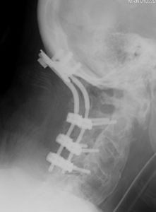 PGpostoplat 221x300 - 61 yo male with severe cervical stenosis and myelopathy
