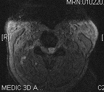 PGpreopaxialmri - 61 yo male with severe cervical stenosis and myelopathy