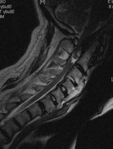 PGpreopsagMRI 228x300 - 61 yo male with severe cervical stenosis and myelopathy
