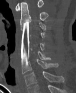 VHpostopCT 246x300 - 49 yo male with kyphosis s/p failed cervical fracture repair
