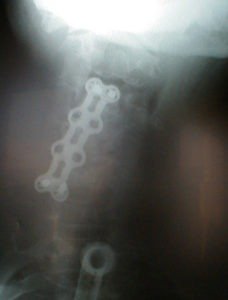 VHpreopAP 228x300 - 49 yo male with kyphosis s/p failed cervical fracture repair